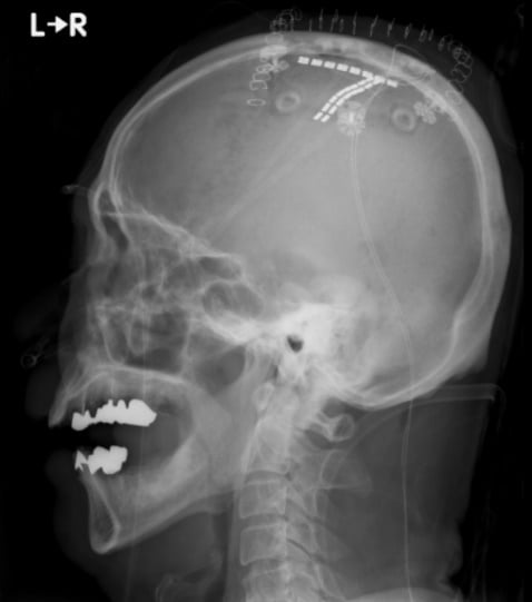 電極を埋め込んだ頭部のレントゲン