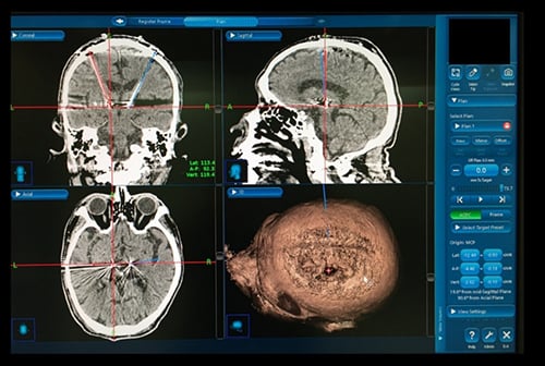 電極を埋め込んだ頭部のMRI画像